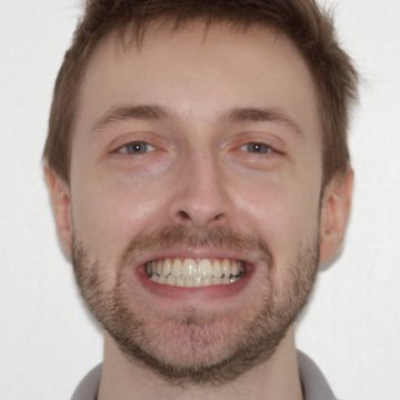 The same MiSmile patient's teeth after Invisalign treatment