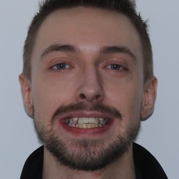 Another MiSmile patient's teeth before Invisalign treatment