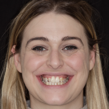 A MiSmile patient's teeth before Invisalign treatment